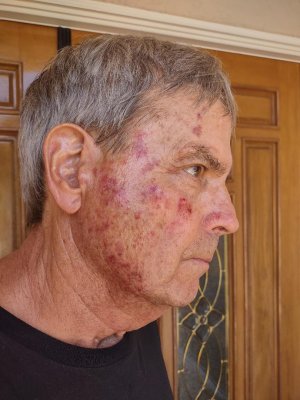 face precancer.jpg